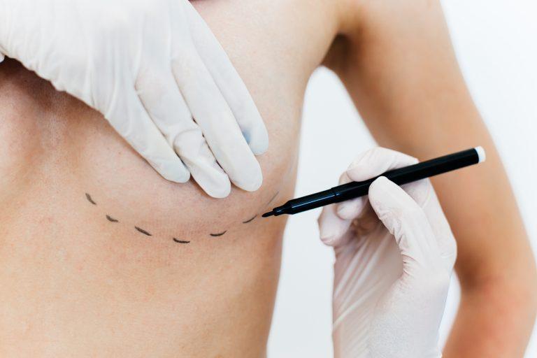 Cirurgia reparadora de mama